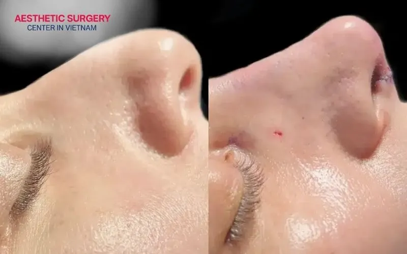Consuming alcohol immediately after a rhinoplasty will cause bleeding inside the nose