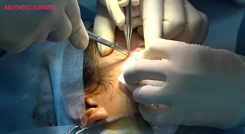 Recovery after facelift surgery often causes soreness and tightness because the tissues beneath the skin are directly affected during the dissection process.