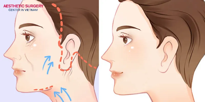 The factors that affect the level of pain after surgery include the surgical technique, individual pain tolerance, and the extent of the procedure.