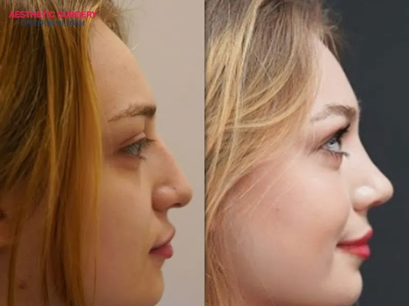 The cost of micro-invasive rhinoplasty typically ranges from VND 30 million to VND 150 million.