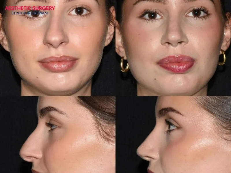 Recovery after rhinoplasty typically progresses through several stages and may take up to 12 months to complete.