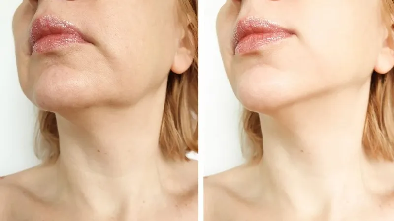 A non-surgical neck lift offers many benefits for patients.