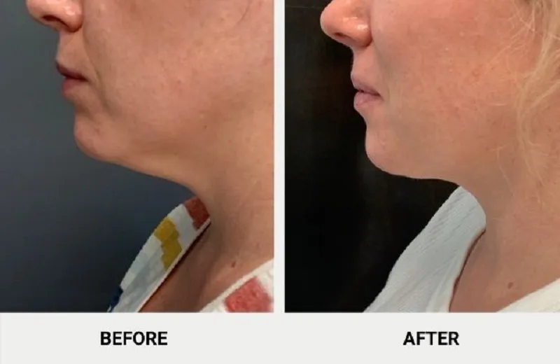 FaceTite and NeckTite help reduce excess fat in the neck while tightening the skin, resulting in a firmer and more elastic neck.