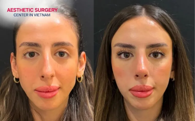 A pretrichial brow lift helps the eyes appear more youthful and lowers the hairline.