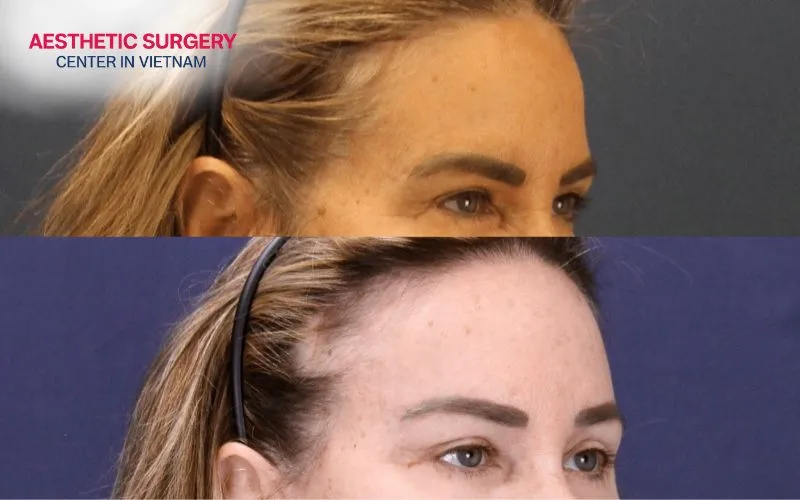 The pretrichial brow lift technique ensures safety and delivers excellent aesthetic results