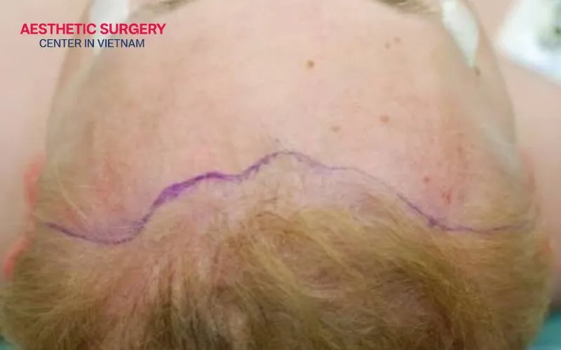 The brow lift incision is made right along the hairline, leaving no unsightly scars.