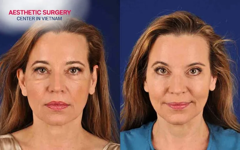 The face looks more youthful after the wound has healed