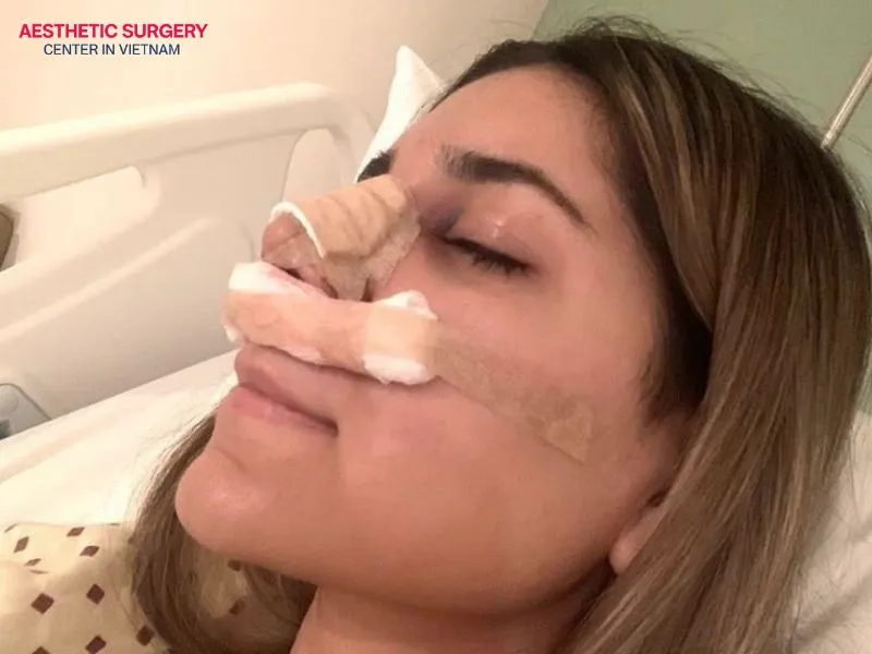 If rhinoplasty side effects occur, timely treatment is essential to achieve the best possible outcome.