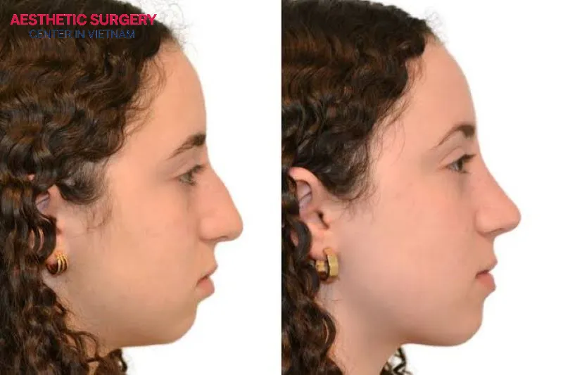 Teenage rhinoplasty helps improve facial balance, reconstruct the nose after trauma, and restore normal breathing function.