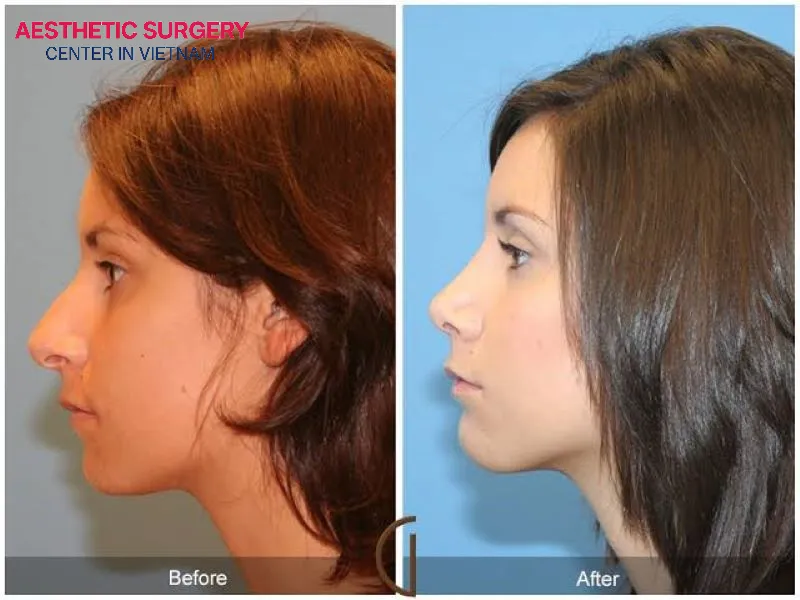 The recommended age for teenage rhinoplasty is 15–16 years old for girls and 16–17 years old for boys.
