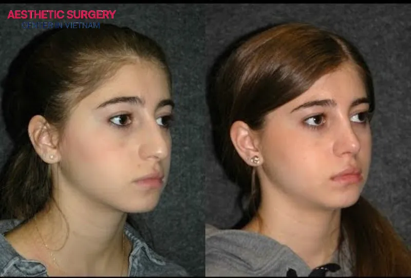 The recovery time after teenage rhinoplasty is typically 1 to 2 weeks.