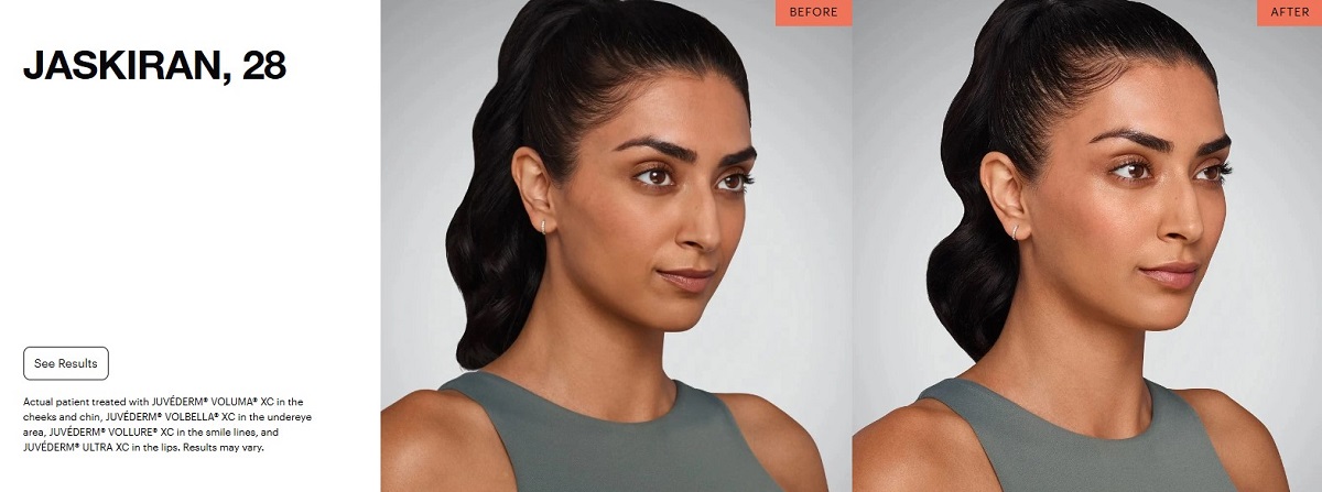 Illustration provided by the manufacturer – JUVÉDERM® Ultra XC is FDA-approved for indicated treatment areas, including the nasolabial folds and the lips.