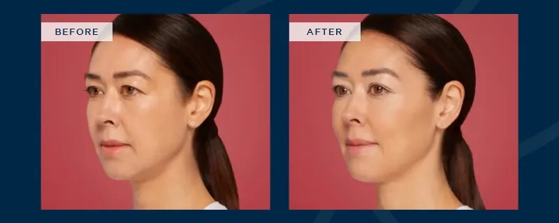 The U.S. FDA has approved Restylane® Contour for cheek augmentation, correction of midface contour deficiencies, and improvement of temple hollowing.