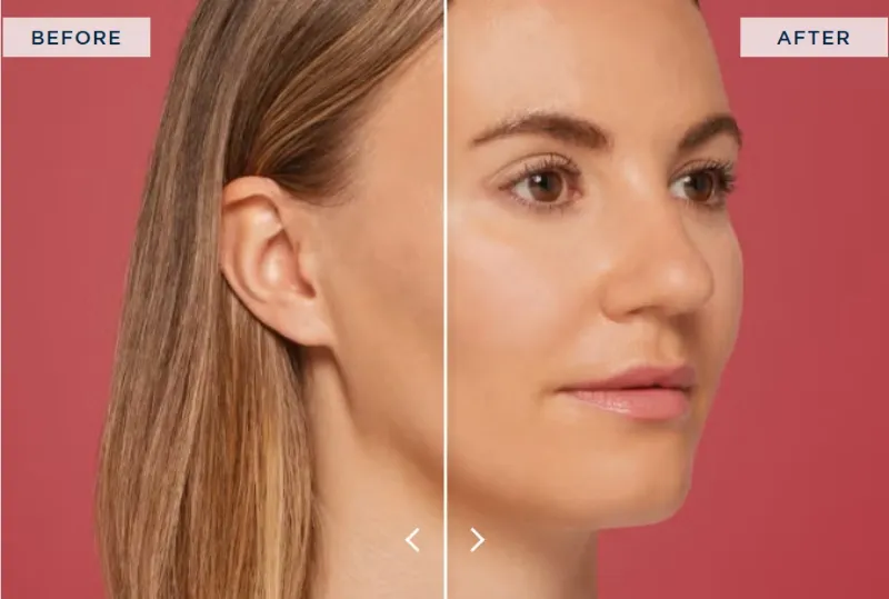 Restylane® Contour helps create a fuller, more balanced, and naturally refined facial appearance.