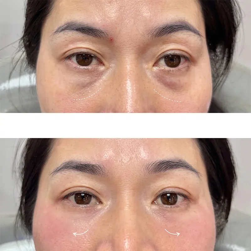 Illustration provided by the manufacturer – Patients treated with Restylane® Eyelight showed a noticeable improvement in the appearance of under-eye hollowing before and after treatment.