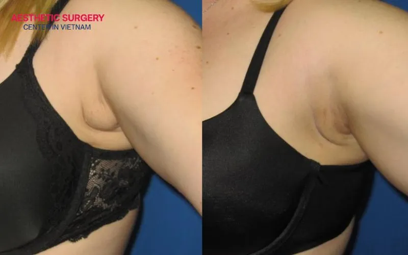 Before and after results of armpit liposuction, helping the appearance of this area look slimmer and more natural.