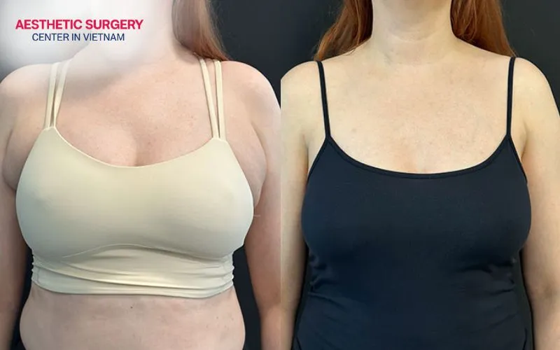 Armpit liposuction is not painful; there is only a feeling of soreness that will subside after 2 to 4 weeks.