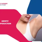 What is armpit liposuction? Ideal candidates, benefits and costs