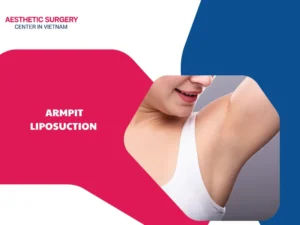 What is armpit liposuction? Ideal candidates, benefits and costs
