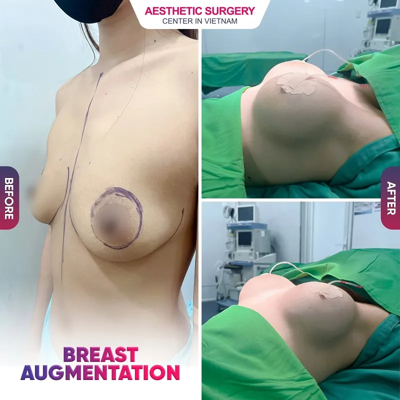 Before and after images of a client's breast augmentation at the Aesthetic Surgery Center in Vietnam, performed personally by Dr. Nguyen Kim Khoa.
