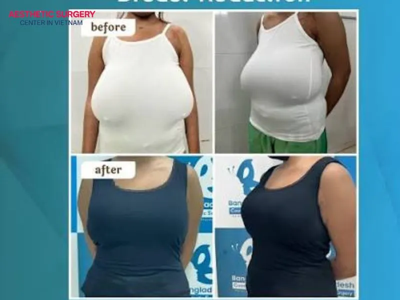 There are many breast reduction techniques. Depending on breast size and individual needs, the surgeon will recommend the most suitable method.