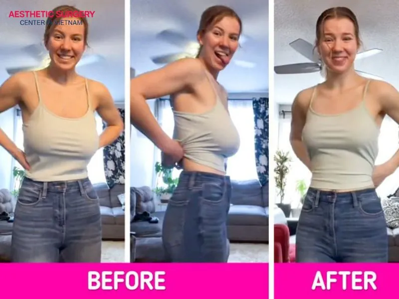 Breast reduction surgery does not provide permanent results, but the fatty tissue removed during the procedure will not return