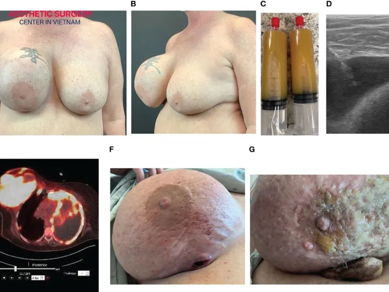 Breast implant-associated anaplastic large cell lymphoma can cause several noticeable signs and symptoms