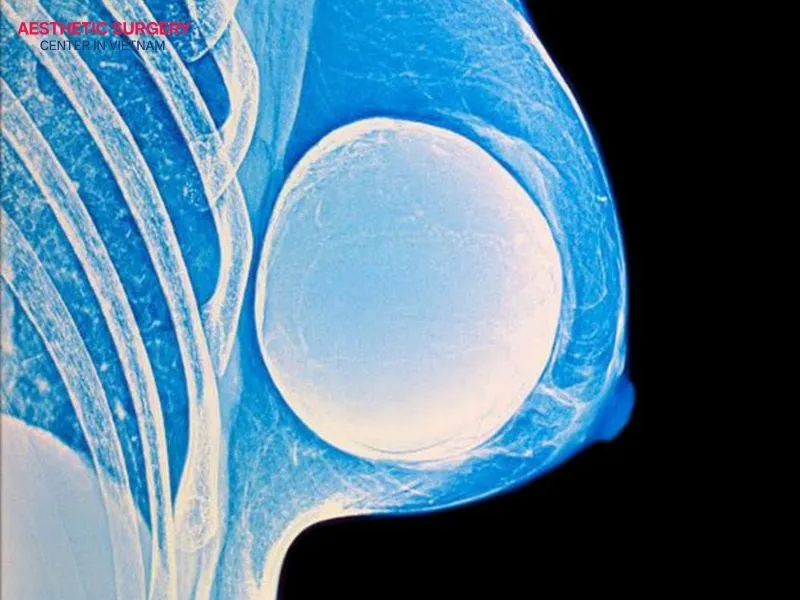 Gummy bear breast implants are generally safer and can last for a long time.