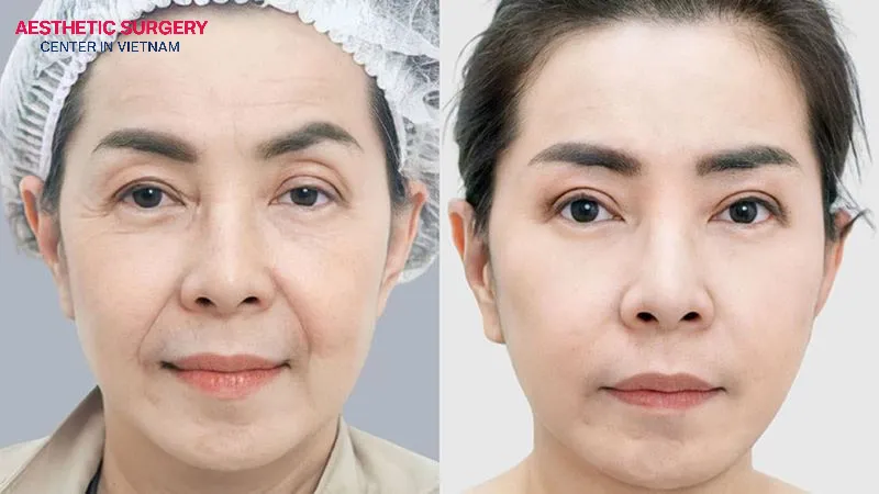 How long after a facelift can I color my hair? The safe timeframe is 4–6 weeks.