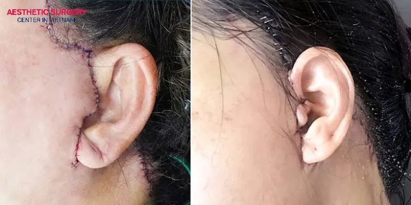 After dyeing your hair, you should closely monitor the facelift incision line