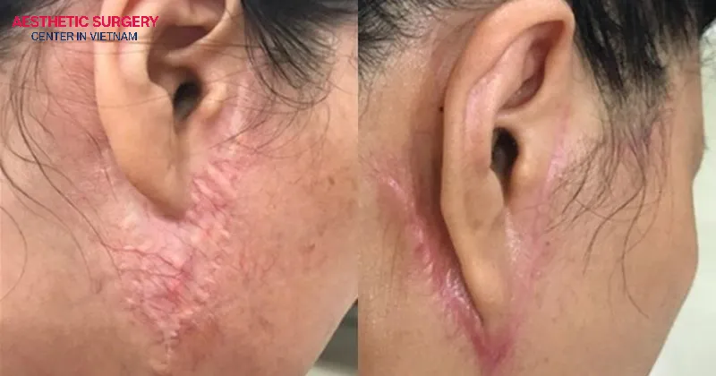 Dyeing your hair too soon can lead to the formation of keloids or dark scars