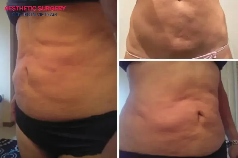 Bulging or protrusion following liposuction
