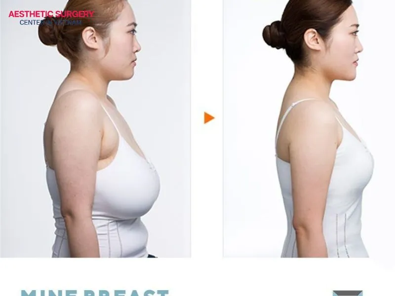 Liposuction only breast reduction has many differences compared with traditional breast reduction surgery.