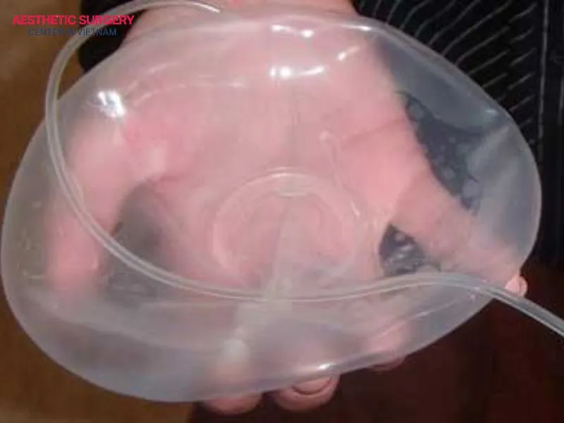 The main component inside saline breast implants is a 0.9% NaCl solution.