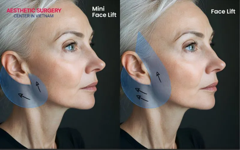 The recovery time and the return to your favorite sleeping position are also determined by the technique of each facelift method.