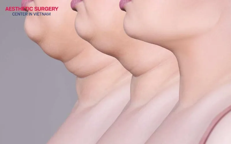 Surgical double chin contouring delivers noticeable and long-lasting results
