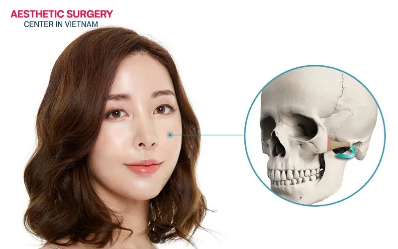 After zygoma reduction surgery, discomfort usually lasts for the first 2 days and then gradually subsides.