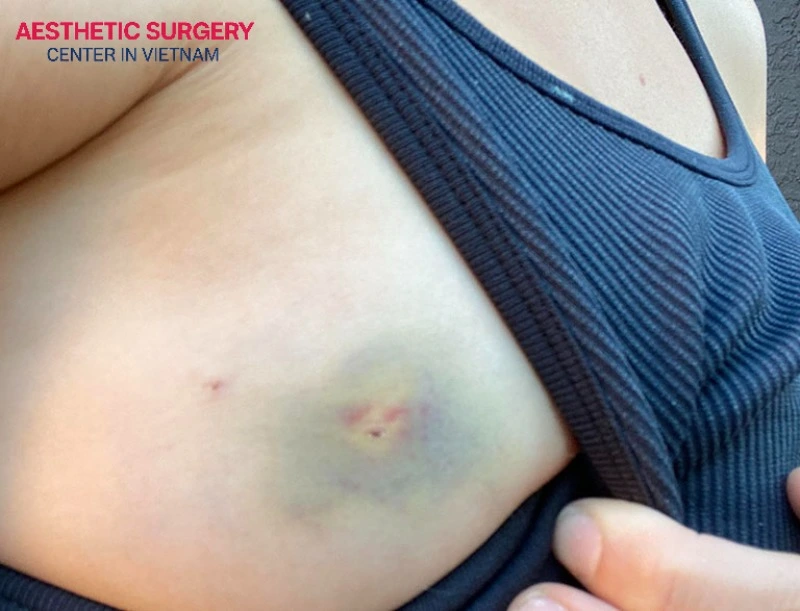 The most critical danger of flying prematurely following breast augmentation is the elevated risk of deep vein thrombosis and blood clots.