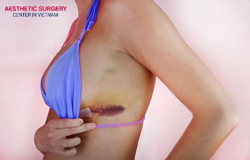 Flying too early after surgery can trigger hematoma formation or surgical site infections.