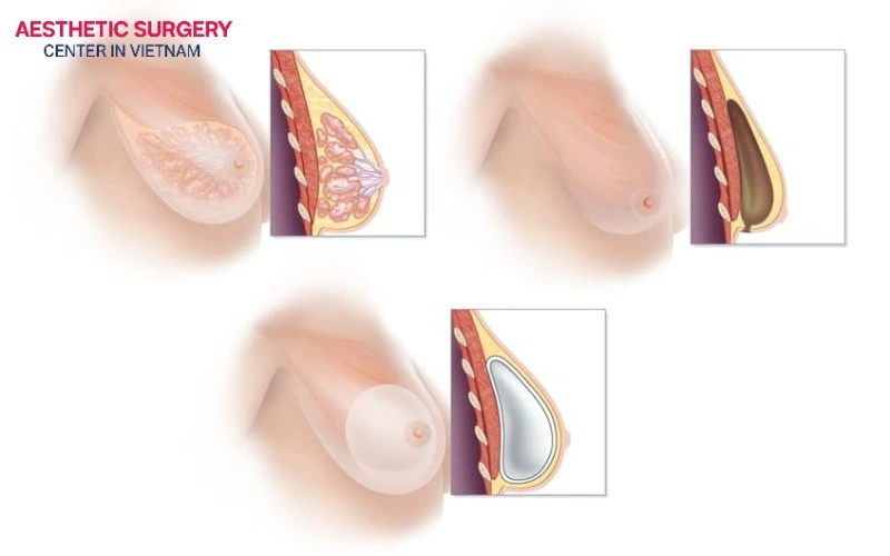 Surgical pocket technique and implant characteristics directly dictate healing speed and travel clearance.