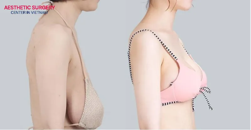 A breast lift is also a popular surgical solution associated with breast implants.)