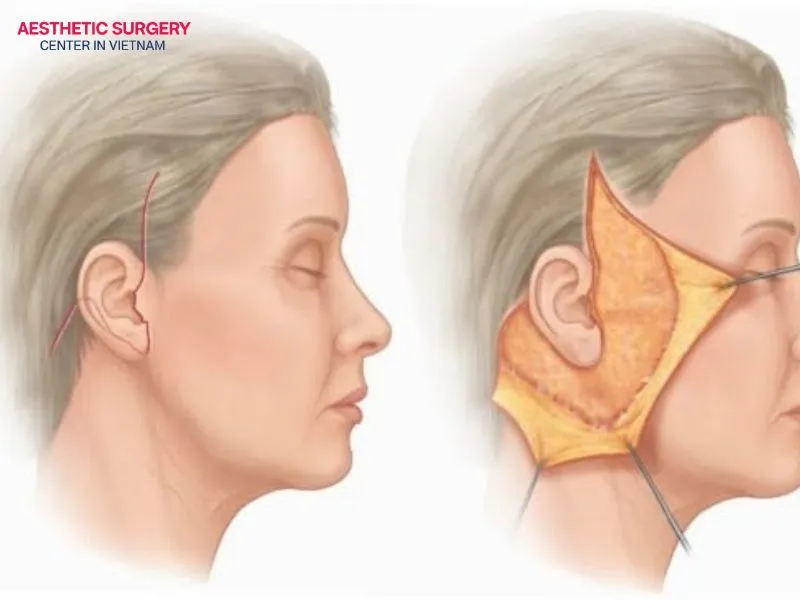 The SMAS facelift procedure requires a high level of precision and an experienced surgeon to perform it.