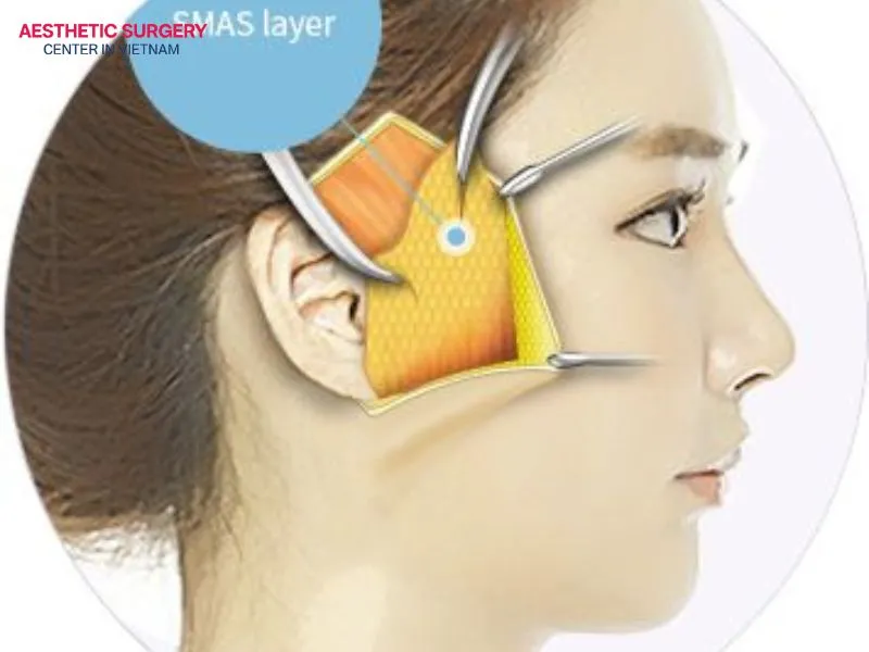 The SMAS facelift offers many outstanding benefits, making it a popular choice among patients.