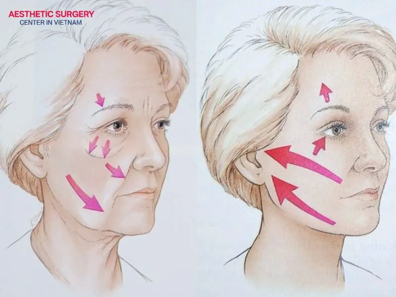 Although the SMAS facelift is considered a safe technique, it still carries certain risks.