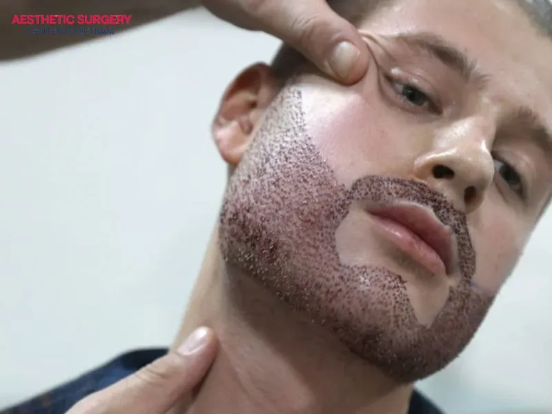 A beard transplant is a solution that helps enhance a more masculine appearance for men.