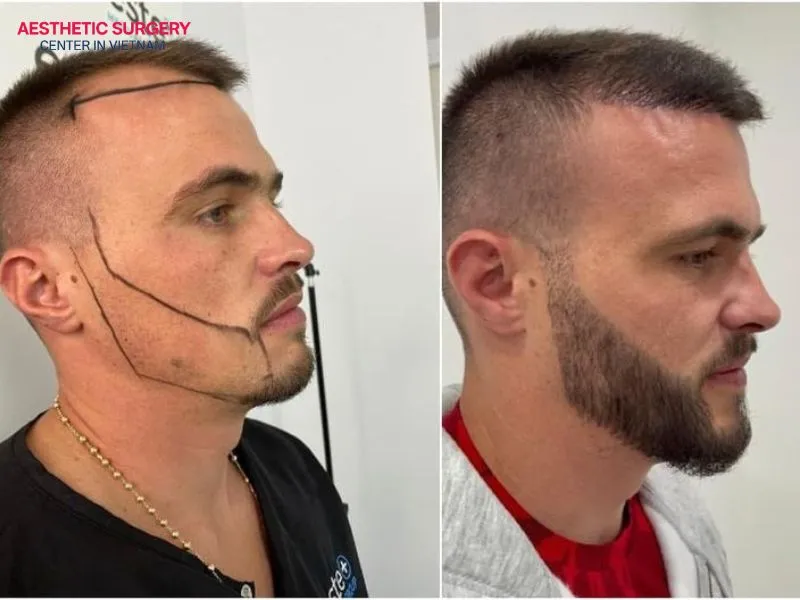 A beard transplant is a long-lasting solution that can provide both aesthetic and psychological benefits for men.
