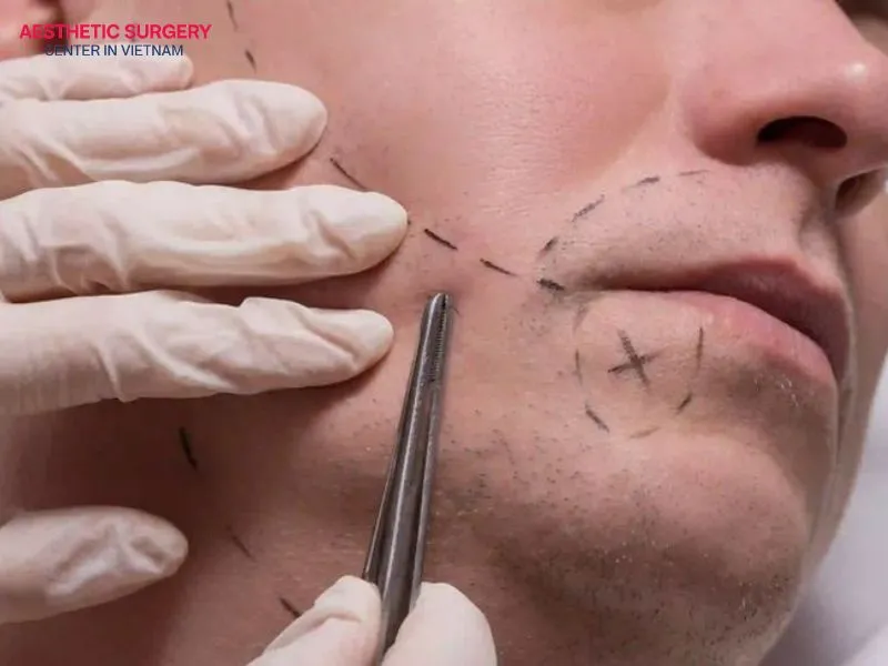 The FUE facial hair transplant technique extracts individual hair follicles from the donor area without causing extensive tissue damage.