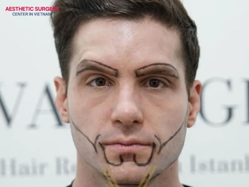 Before a beard transplant, the surgeon will advise you on the beard style and the number of hair follicles needed.