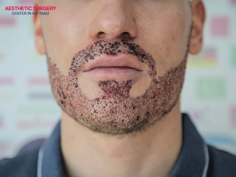 The hair follicle transplantation step plays an important role and largely determines the aesthetic results of a beard transplant.