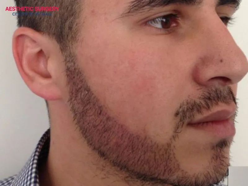 It is important to understand the recovery process after a facial hair transplant to follow the proper aftercare instructions.